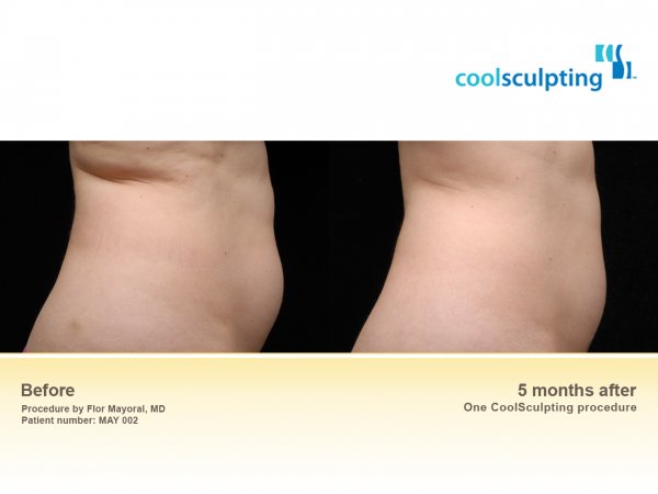 Coolsculpt-3