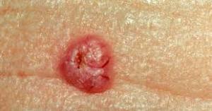 skincancer2
