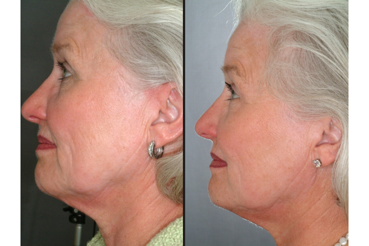 skinpen1