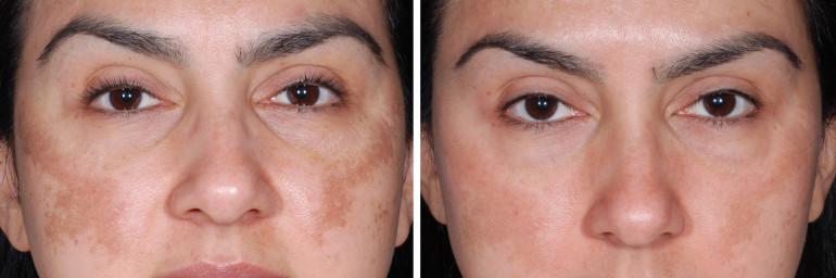 skinpen2