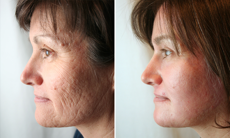 skinpen3