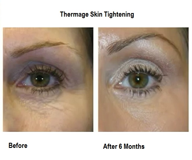 thermage-2
