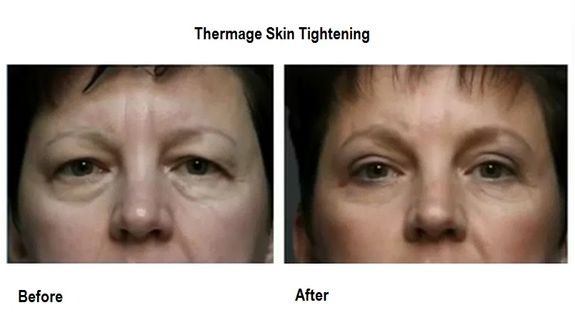 thermage-3
