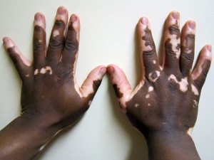 vitiligo1
